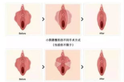 私密缩小用什么手术方式,揭秘手术方法与美丽蜕变之旅